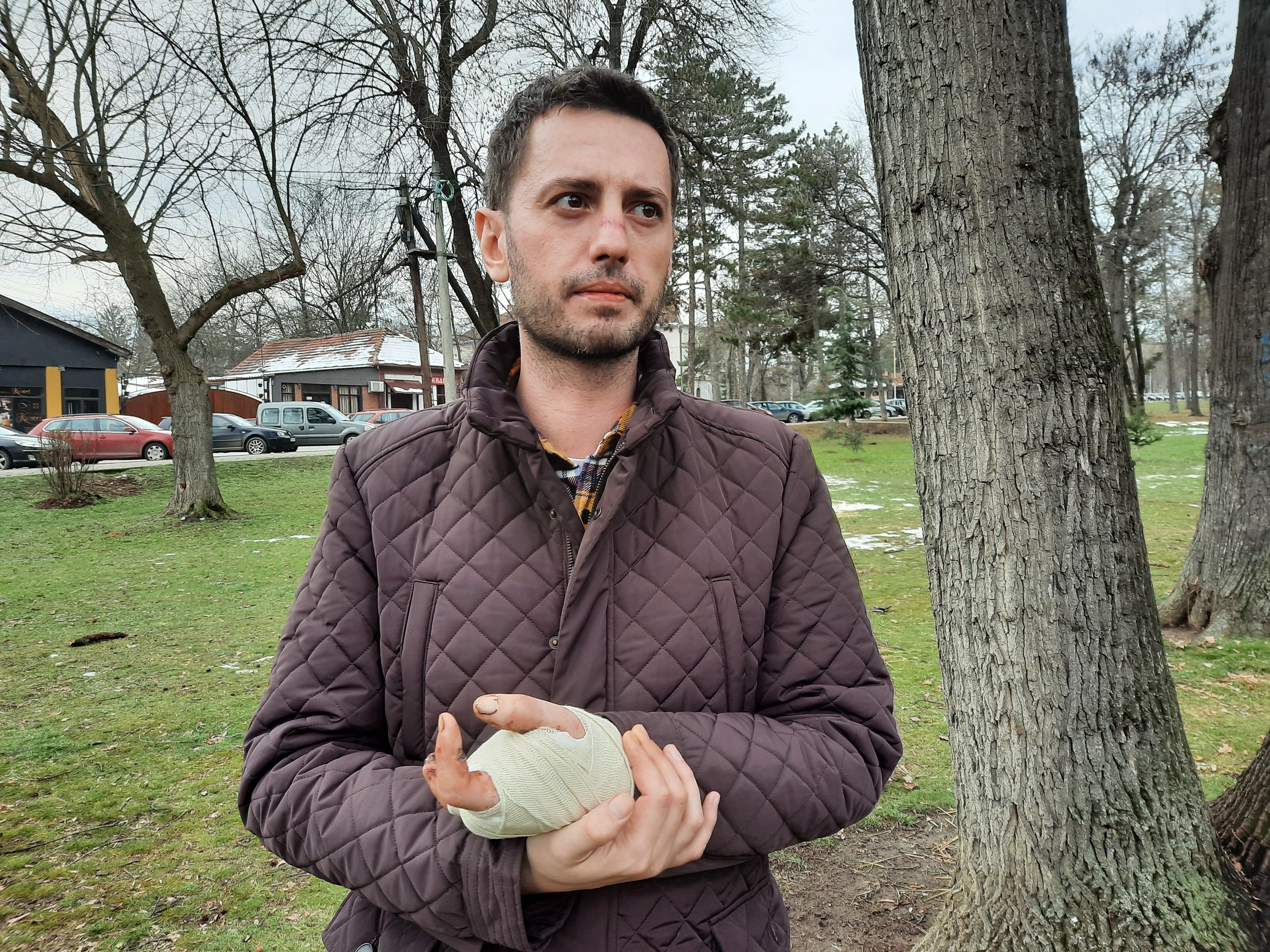 Nikola Ćirković, petarda, povreda Foto: Aleksandra Petrović/Nova.rs