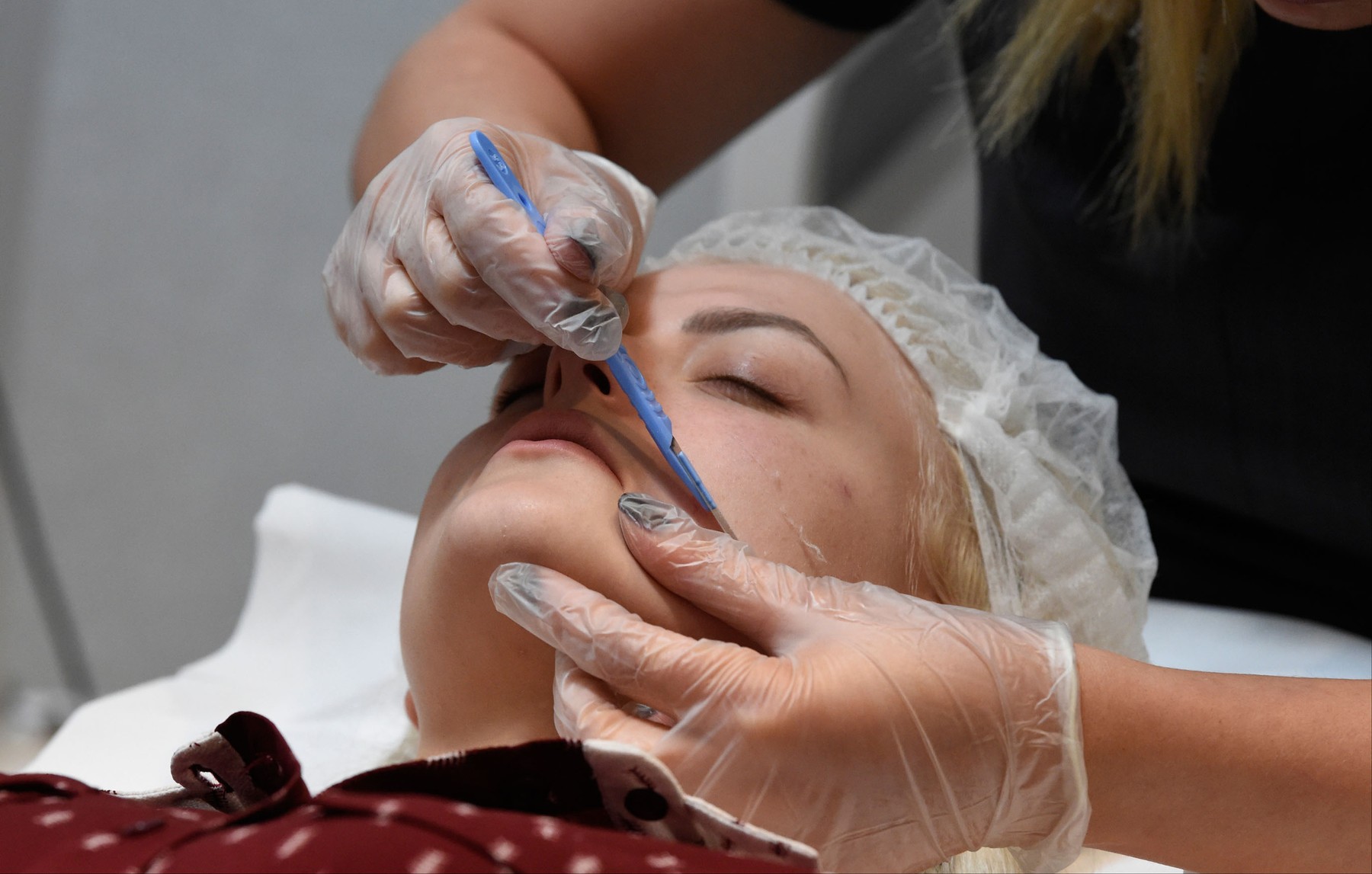 dermaplaning
