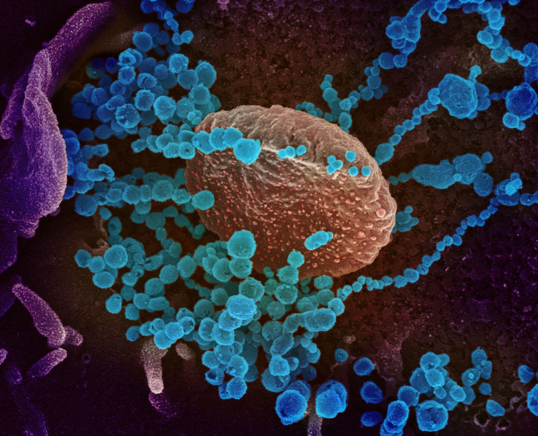 COVID-19. Novel Coronavirus SARS-CoV-2.This transmission electron microscope image shows SARS-CoV-2also known as 2019-nCoV, the virus that causes COVID-19. isolated from a patient in the U.S., emerging from the surface of cells cultured in the lab. Credit