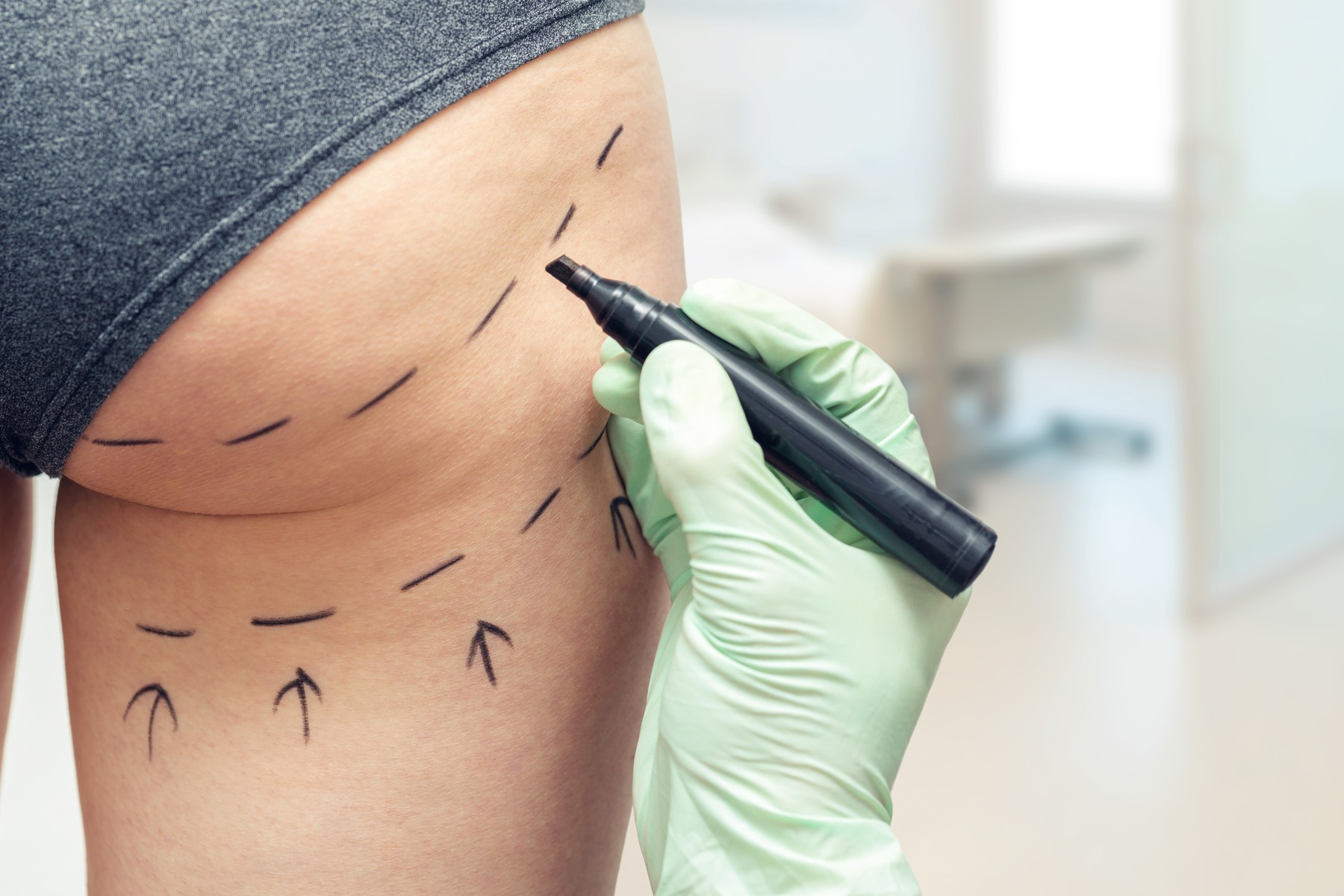 plastic surgeon marking womans body for plastic surgery,Image: 335593569, License: Royalty-free, Restrictions: , Model Release: no, Credit line: Ronalds Stikans / Panthermedia / Profimedia