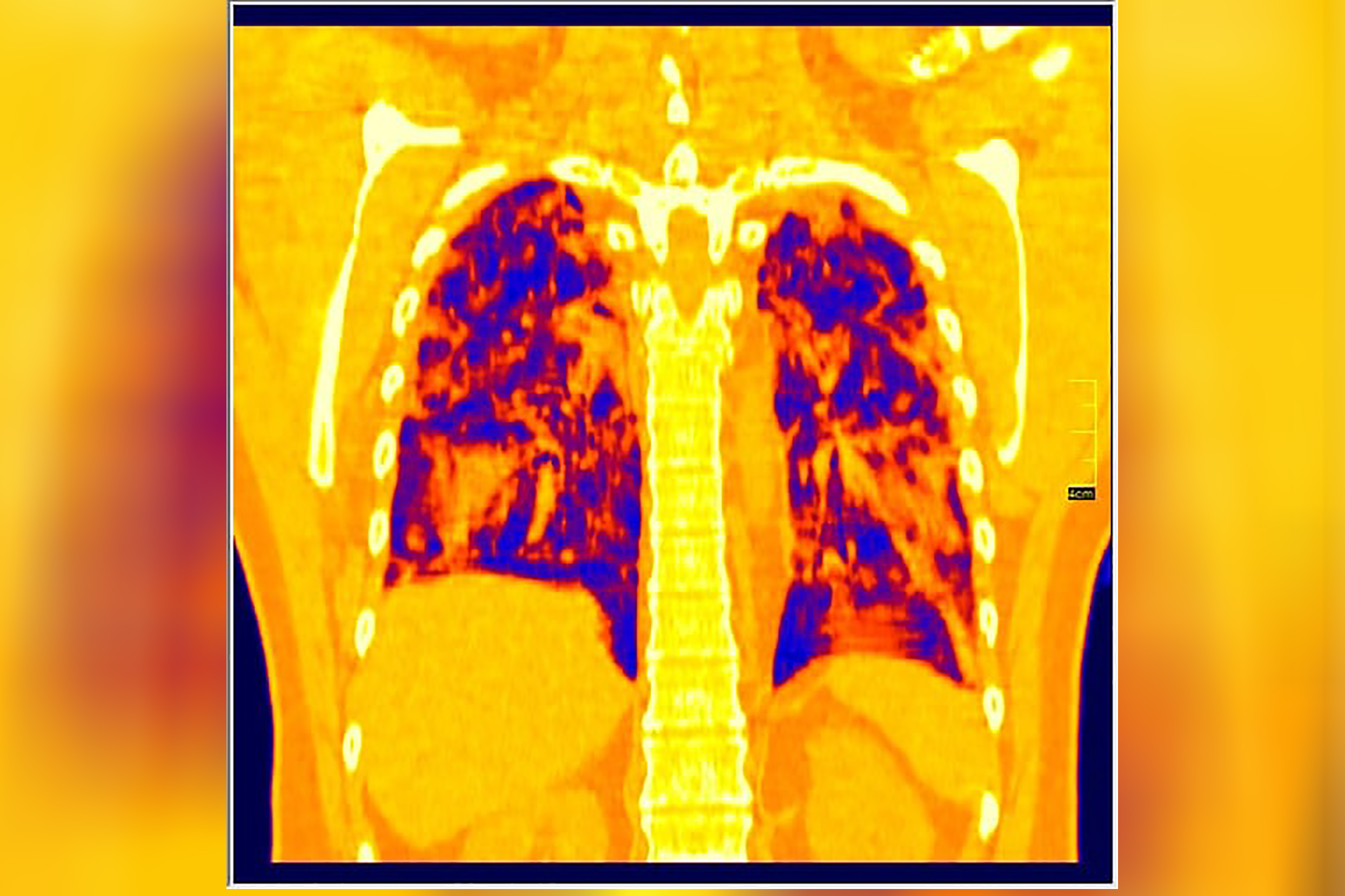 Pluća, Foto: Aleksandar Ivković