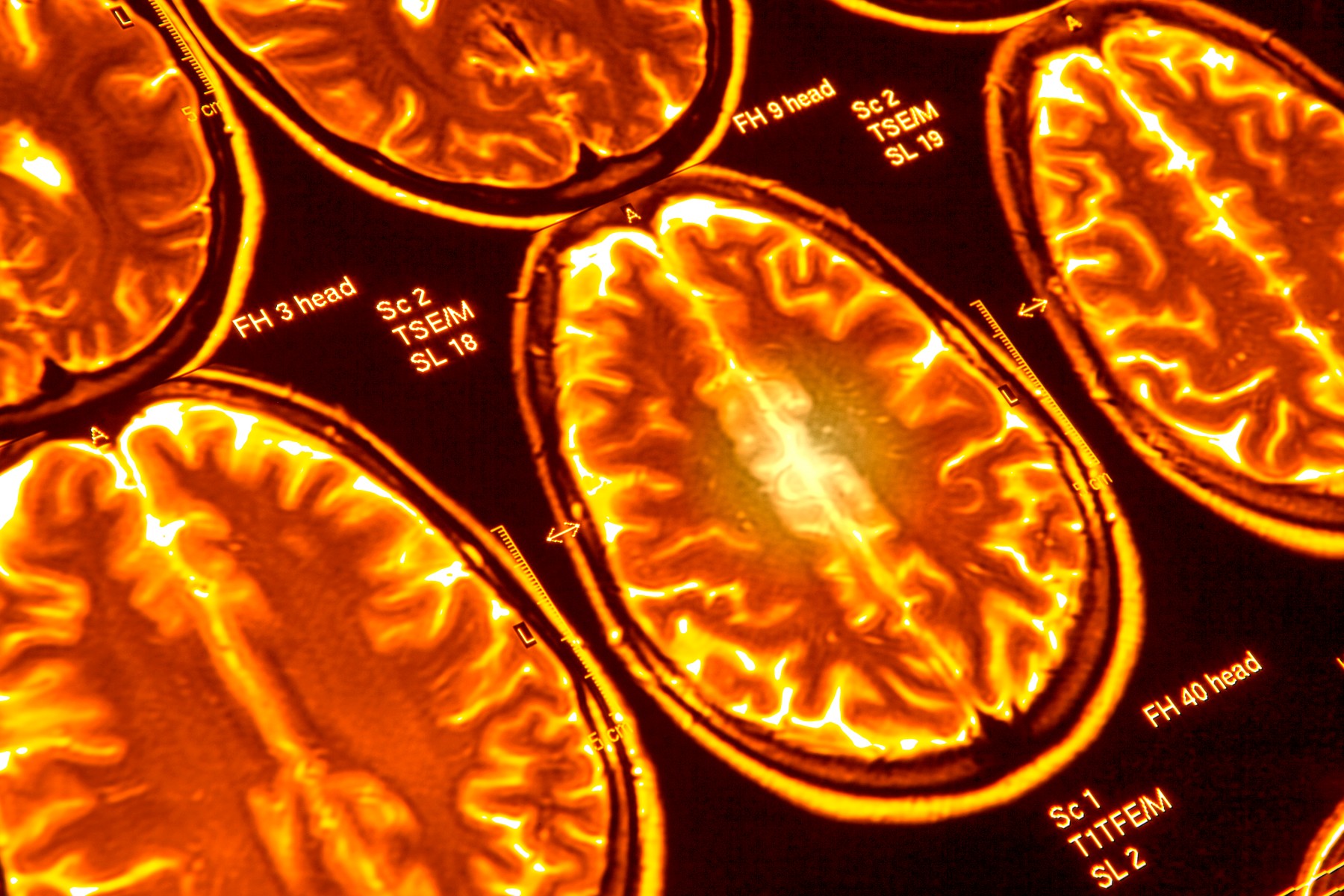 Brain scans, MRI scans