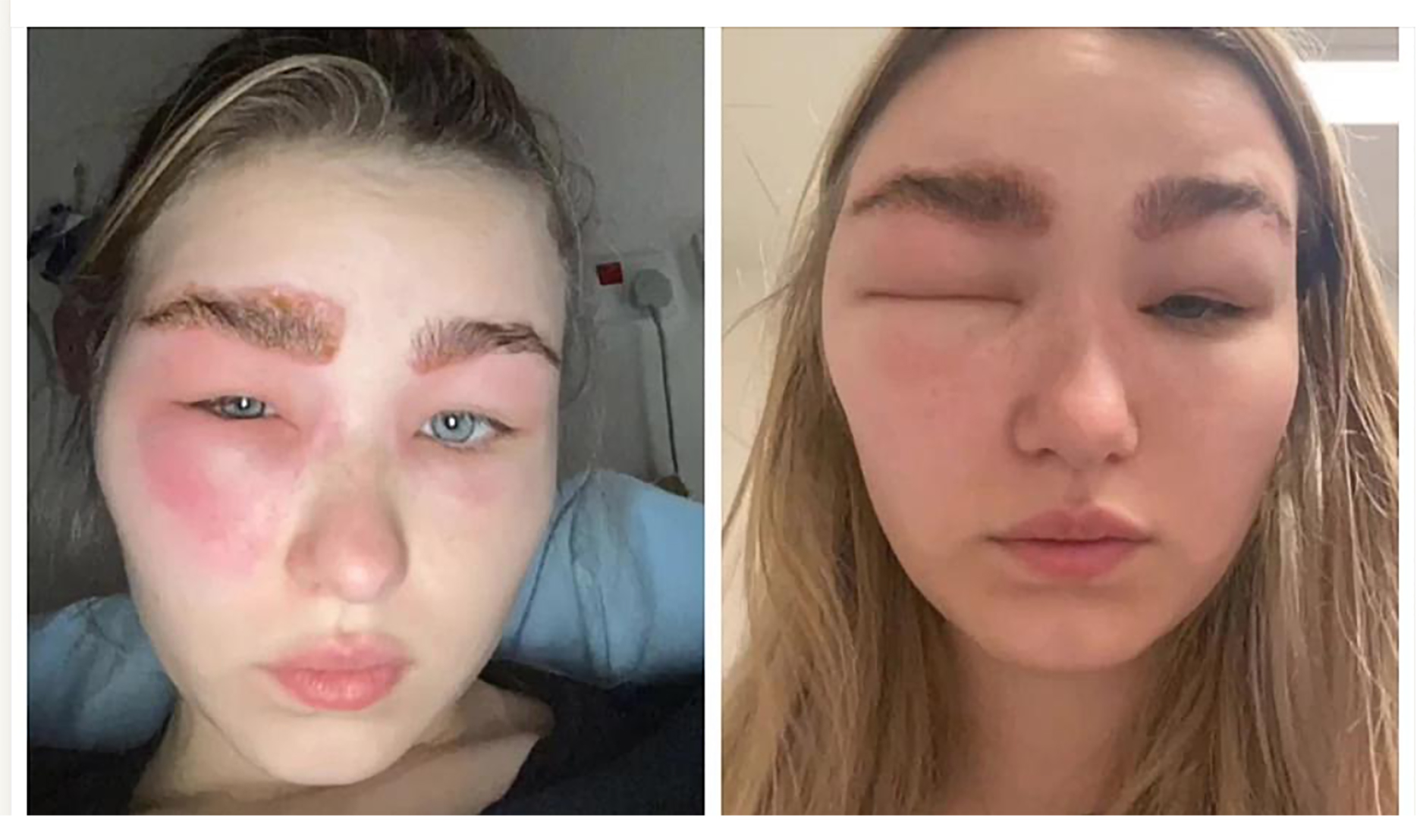 Tretman obrva uzrokovao joj je strašnu alergiju