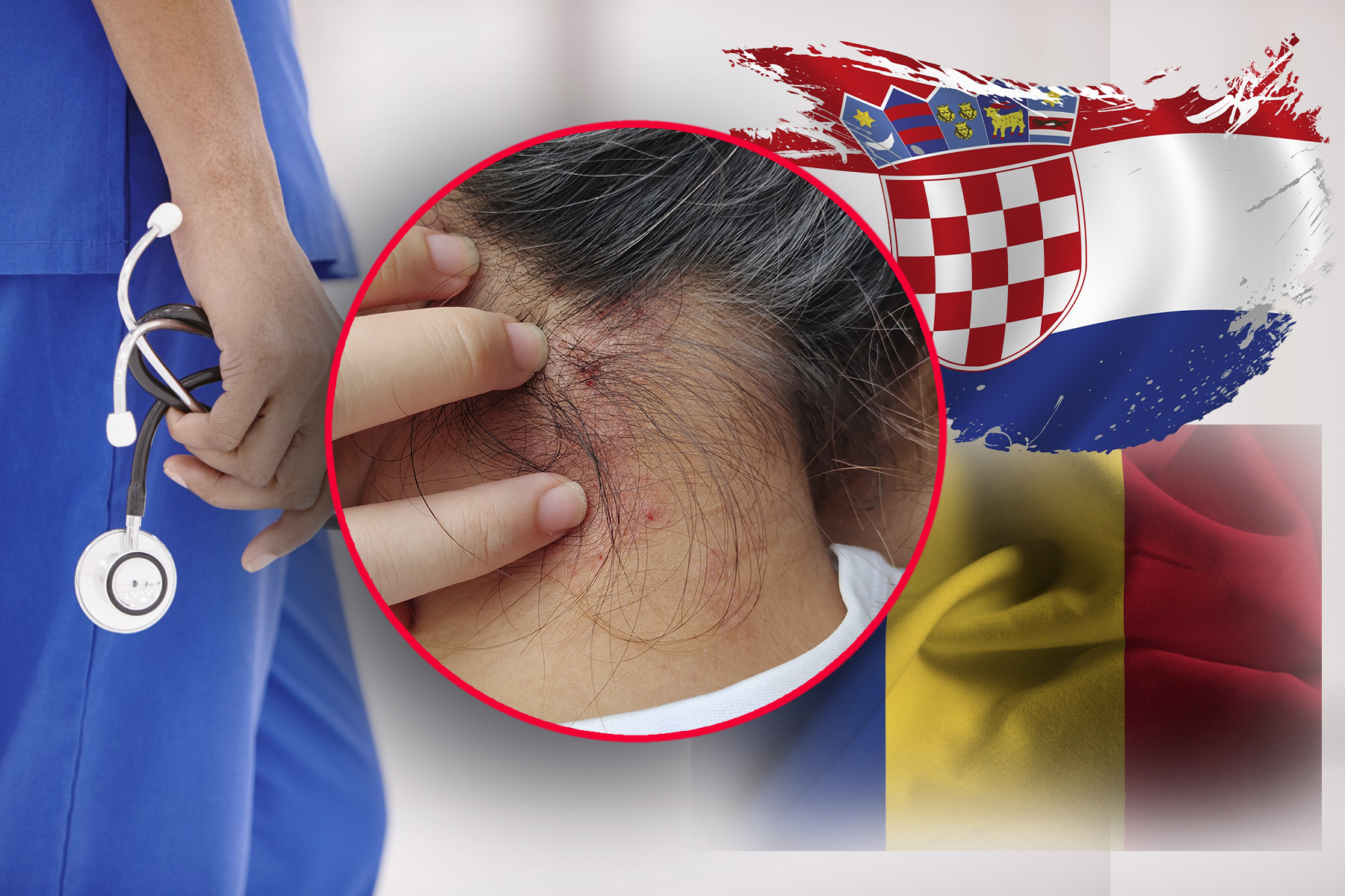 lepra (guba) hrvatska rumunija