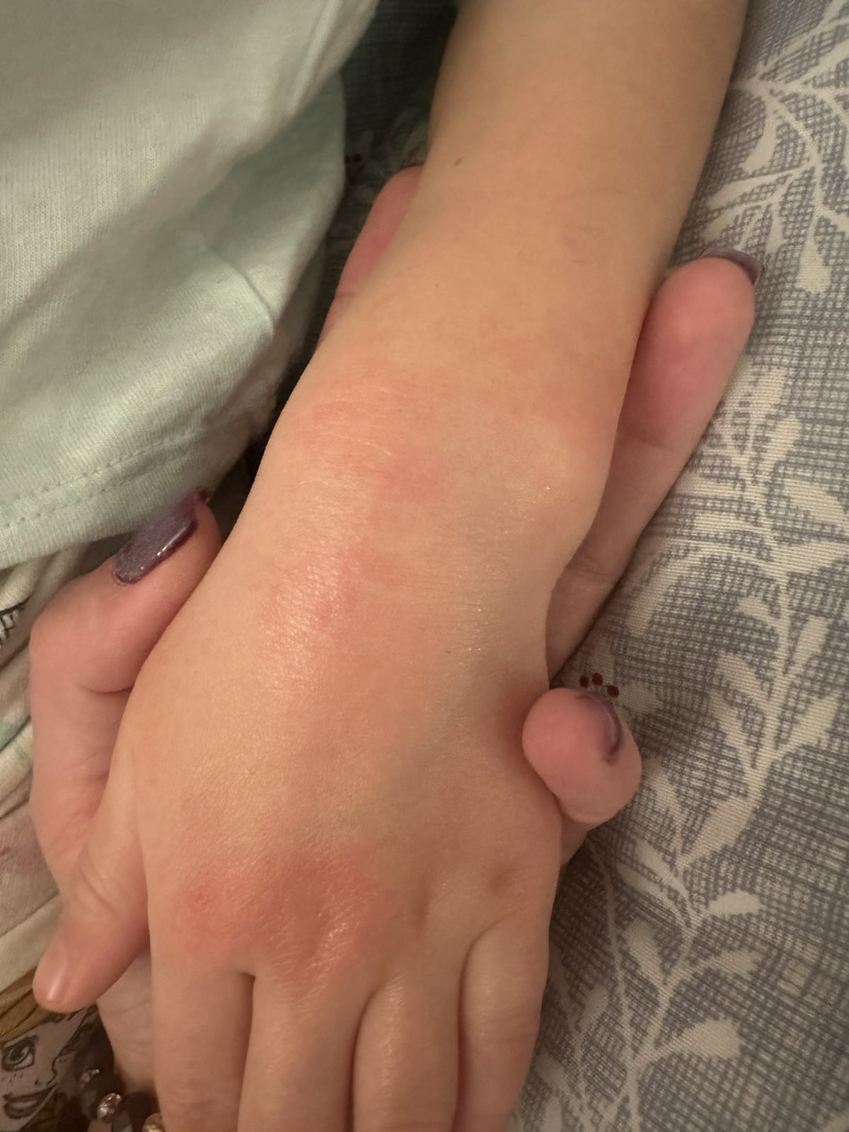 Deca u beogradskim vrtićima dobila osip nakon korišćenja sapuna sapun vrtić