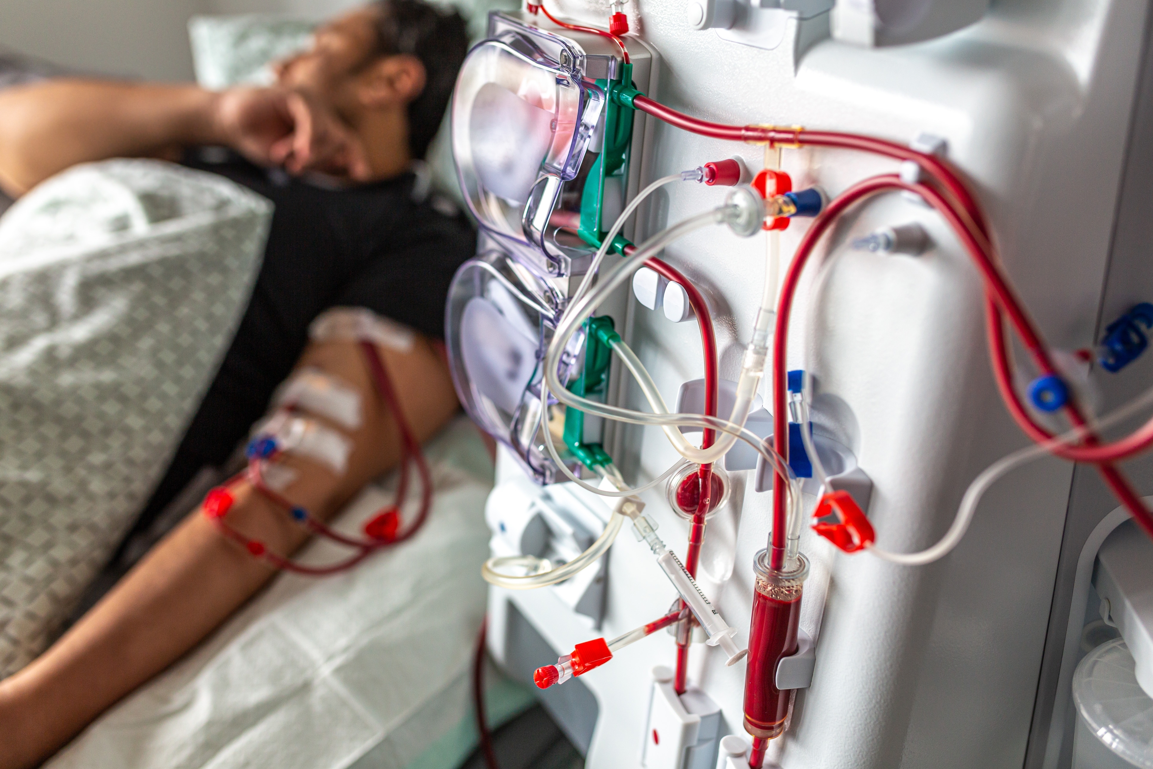 Dijaliza pacijent na dijalizi hantavirus shutterstock_2703792481.jpg