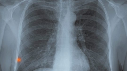 Snimak pluća