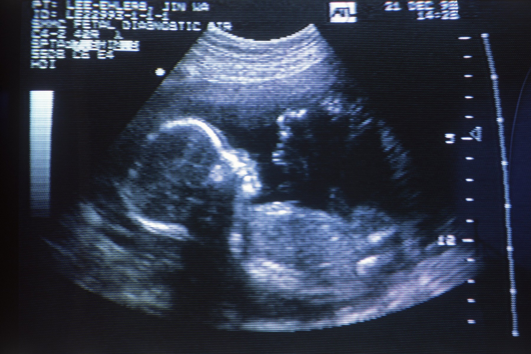 Будет в 44 неделе. УЗИ плода скрининг 1 триместр. III триместр беременности УЗИ. УЗИ беременности 3 скрининг. УЗИ скрининг в 20 недель беременности.