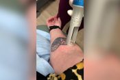 Uklanjanje tetovaža
