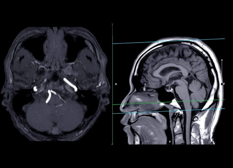 Snimak mozga - ilustracija